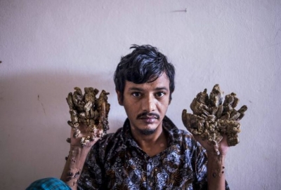 Bangladesh : « L&#039;homme-arbre » veut qu&#039;on lui ampute les mains