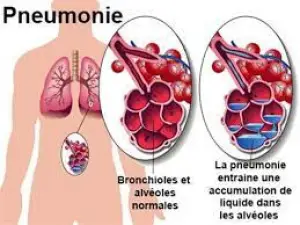 Journée mondiale de la Pneumonie: Un enfant meurt toutes les 20 secondes des suites de cette inflammation