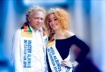 La 5ème édition de la Journée Internationale de sensibilisation à l’albinisme va se dérouler du 21 mai au 31 juin prochain