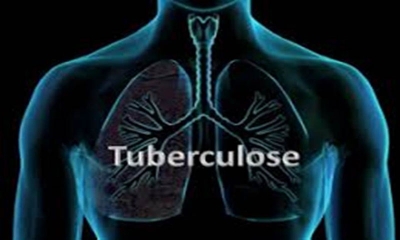 La tuberculose demeure un problème majeur de santé publique au Cameroun