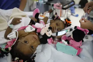 Santé : Les deux petites sœurs siamoises opérées avec succès
