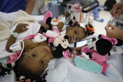 Santé : Les deux petites sœurs siamoises opérées avec succès