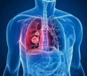 Pneumonie : Causes, symptômes et traitement de la maladie