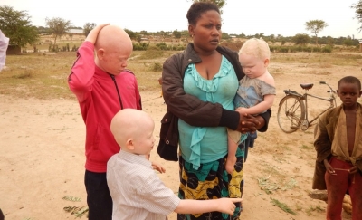 Burundi : Le corps d’un jeune albinos retrouvé démembré