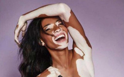 Célébration de la journée mondiale du vitiligo ce 25 juin 2019